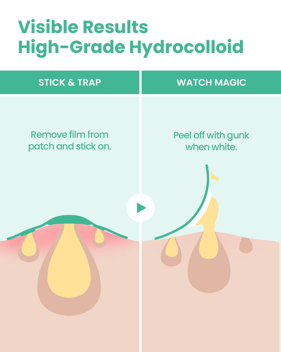 GLAM UP Spotless Nose Patch Hydrocolloid Coverage for Nose Pores, Zits and Oil - Overnight Strong Waterproof to Absorb Blackheads & Pimple Nose Gunk, and Calm with Tea Tree (12 Patches)